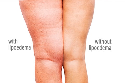 lipedema